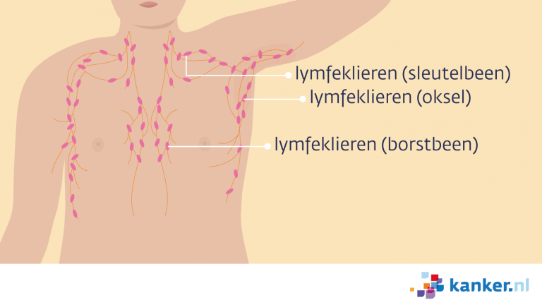 Borstkanker bij mannen: zeldzaam maar  niet onmogelijk